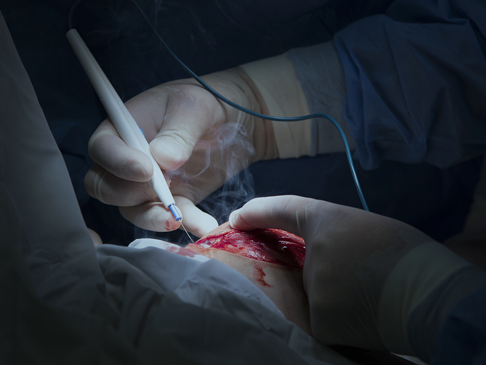 Tips for Managing Surgical Smoke in Your Operating Room